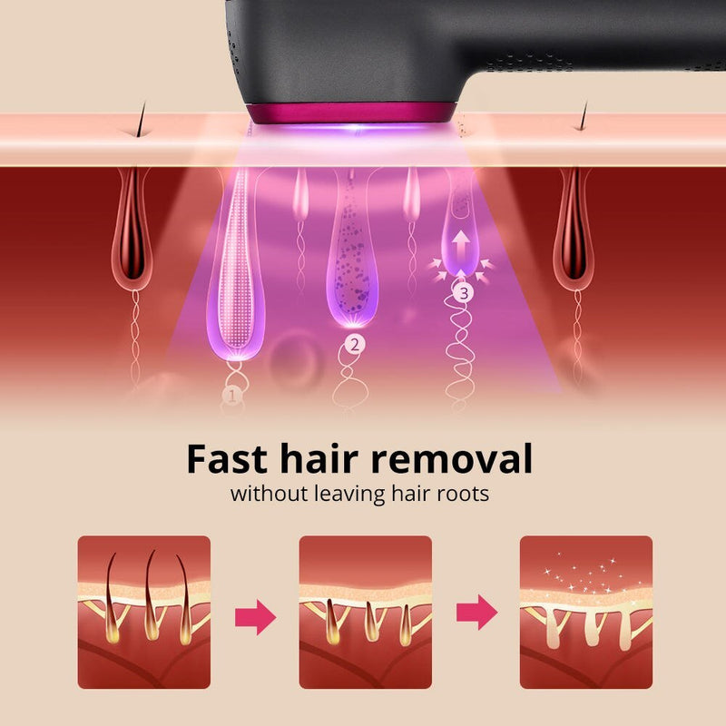 5-Speed IPL Hair Remover – 100k Flashes, Pain-Free Home Laser Device