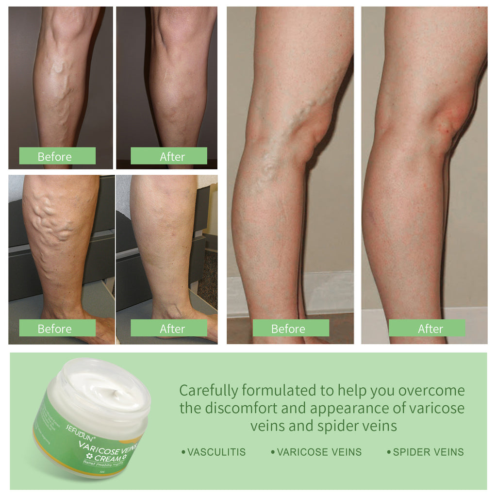 Varicose Vein Repair Cream – Reduces Blood Streaks, Bruises, and Leg Swelling