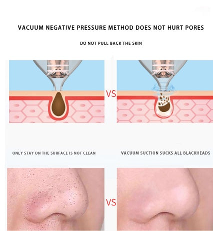 Blackhead Suction Pro – Deep Cleansing Pore Vacuum