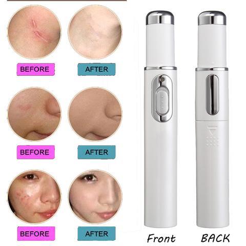 Blue Light Acne Laser Pen – Scar & Wrinkle Treatment