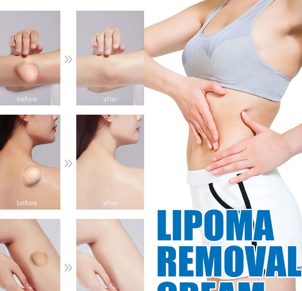 Vital Skin Lipoma Removal Cream