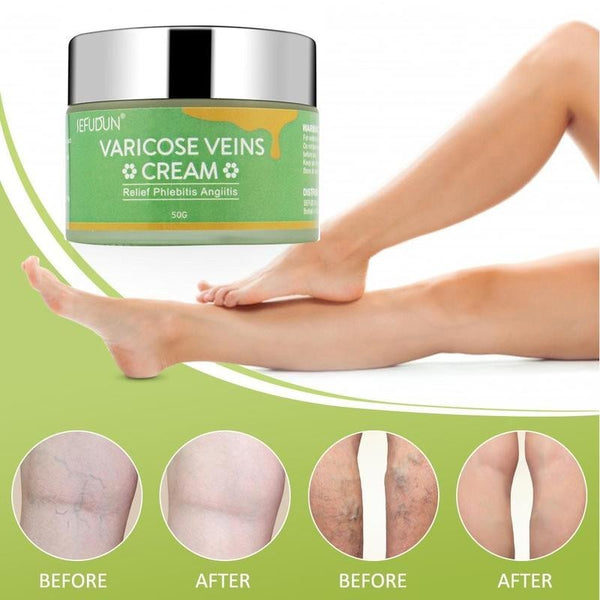 Varicose Vein Repair Cream – Reduces Blood Streaks, Bruises, and Leg Swelling